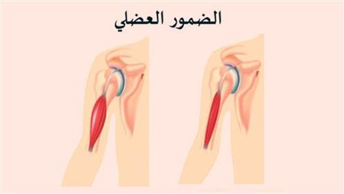 ضمور العضلات: الأسباب، الأعراض، وطرق العلاج الحديثة