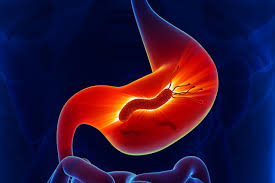 جرثومة المعدة.. أعراضها وعلاجها في دقايق..صحتك أهم