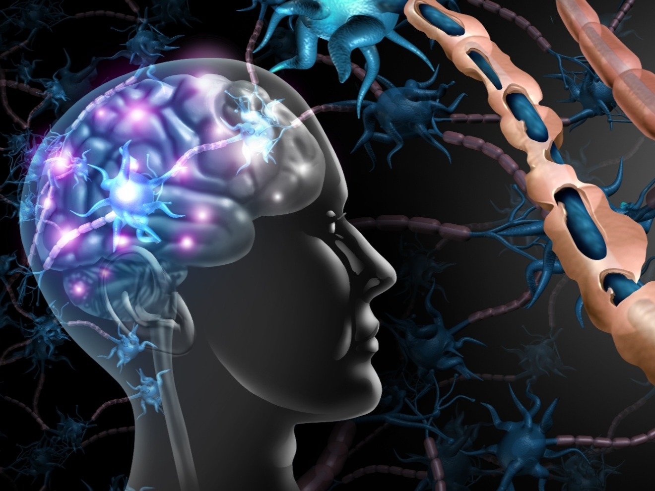 هل تساءلت يومًا ما هو التصلب المتعدد (MS) وكيف يؤثر على الجهاز العصبي؟