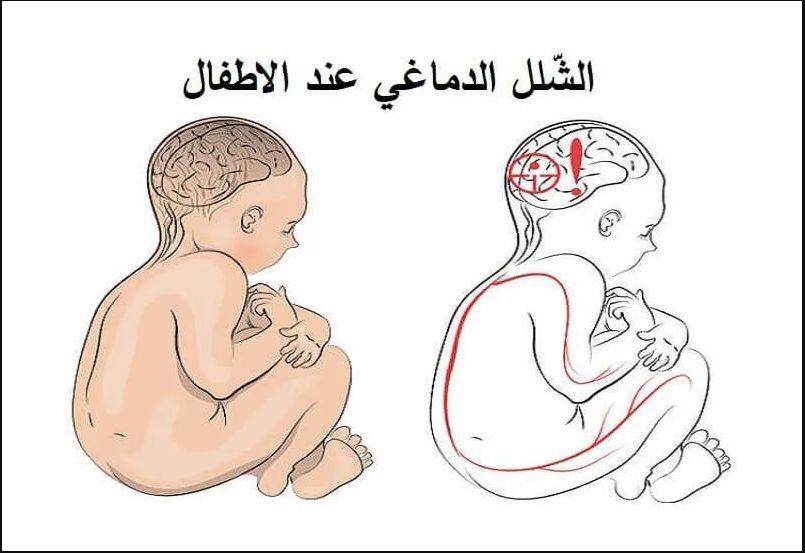 فهم الشلل الدماغي عند الأطفال: تأثيره على الحركة والتوازن