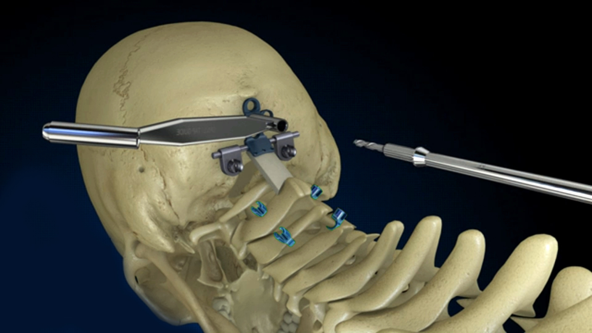 Surgical Procedure Animation
