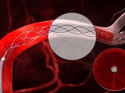 В Нальчике состоится межрегиональная конференция по эндоваскулярным технологиям в лечении ишемического инсульта