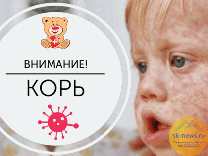 В Ставрополе, Пятигорске, Кисловодске и двух сельских округах люди заразились корью