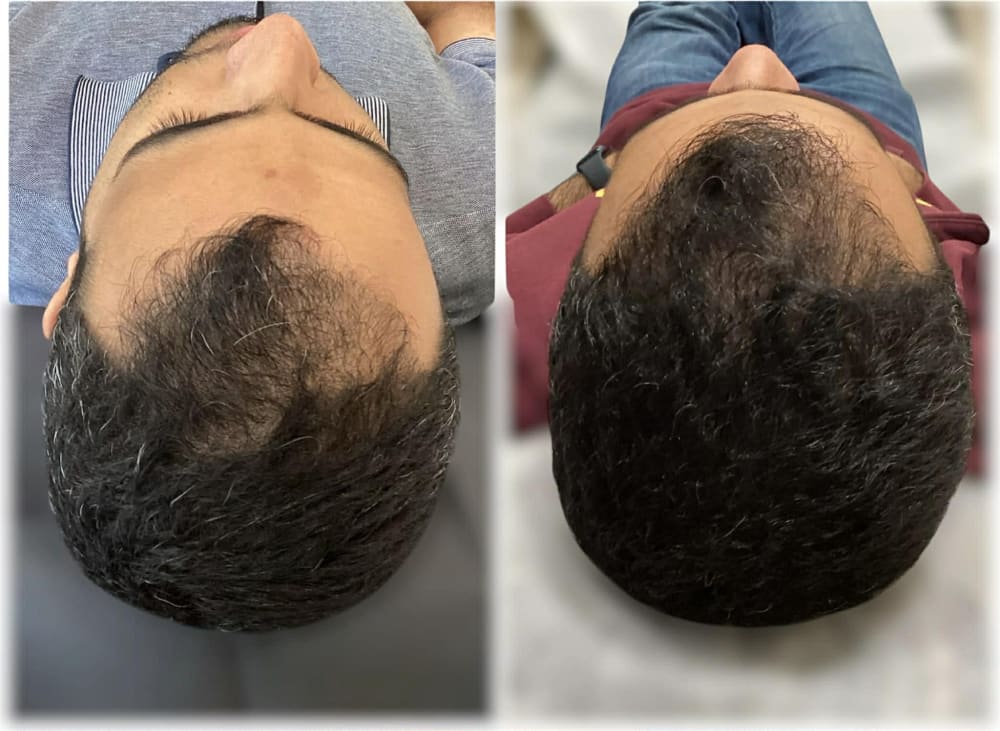 Résultat avant après 2