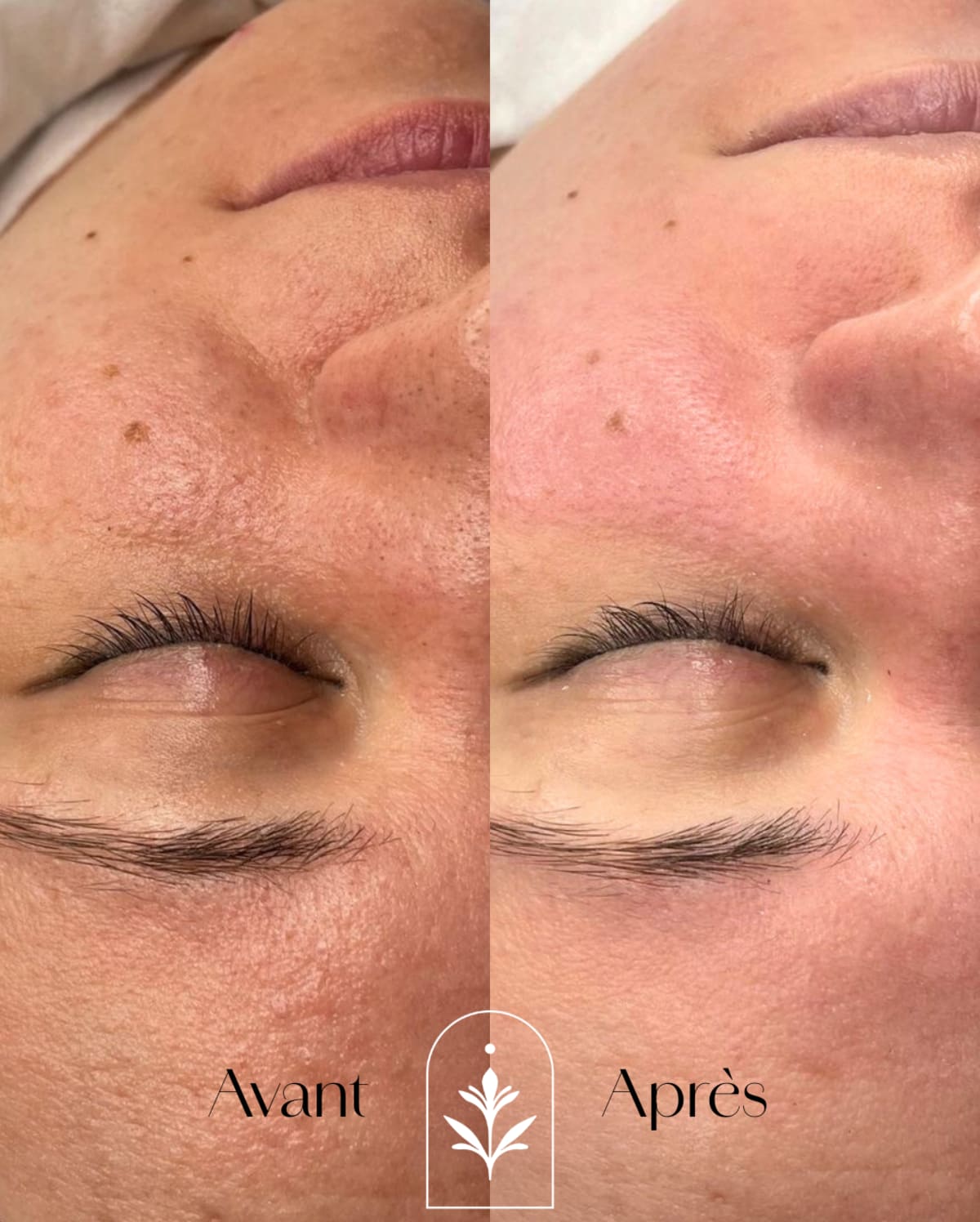 Care & post-peel guidance