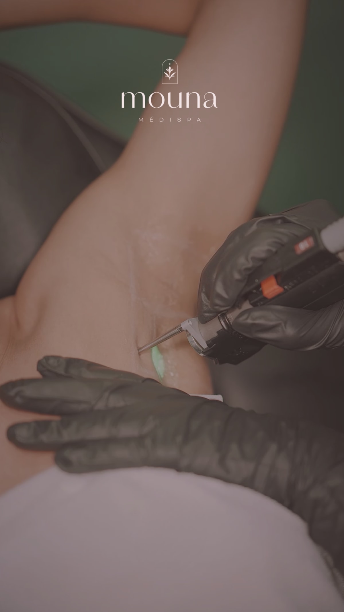 Traitement laser Elite iQ®