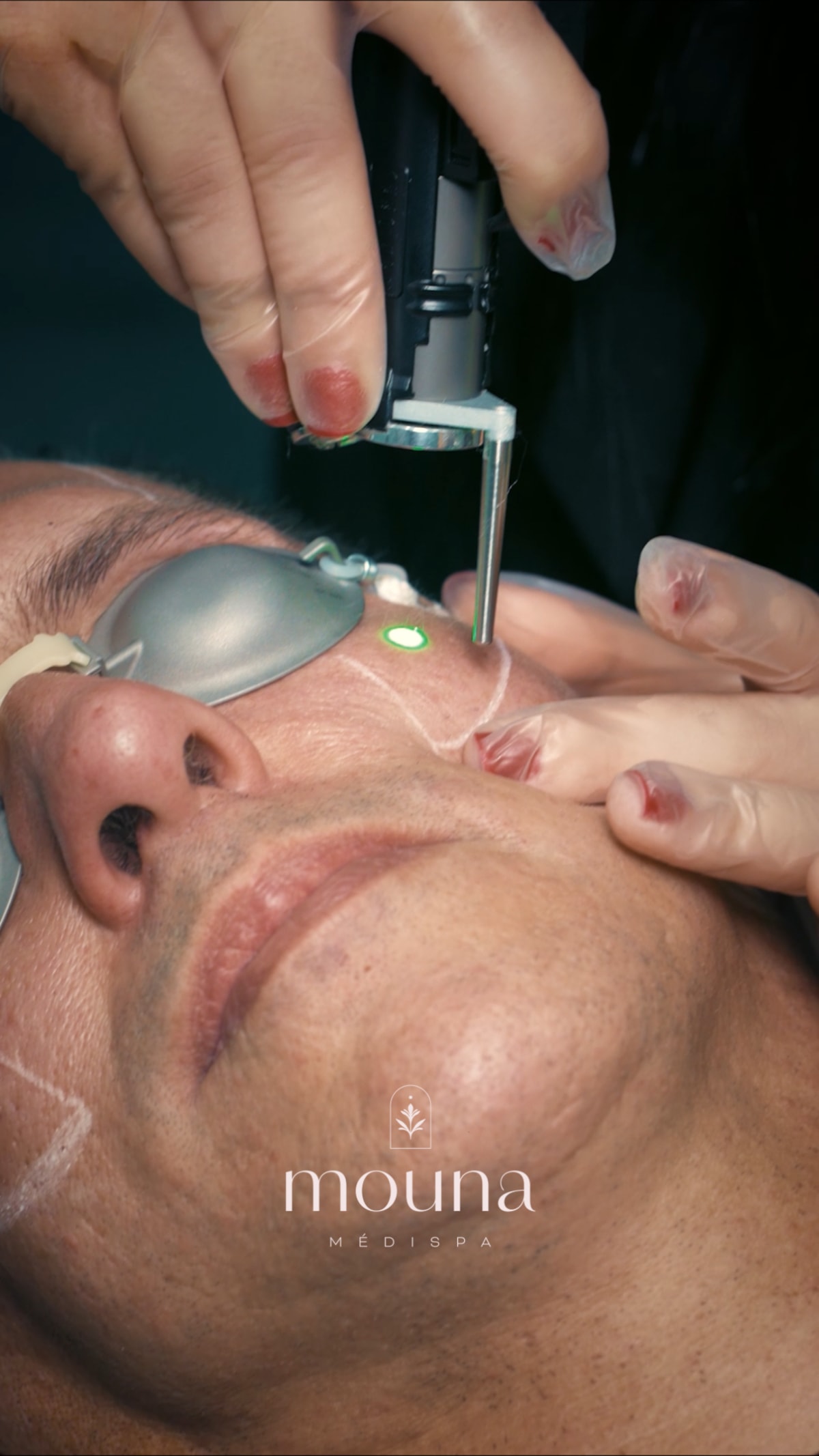 Photorajeunissement Elite iQ