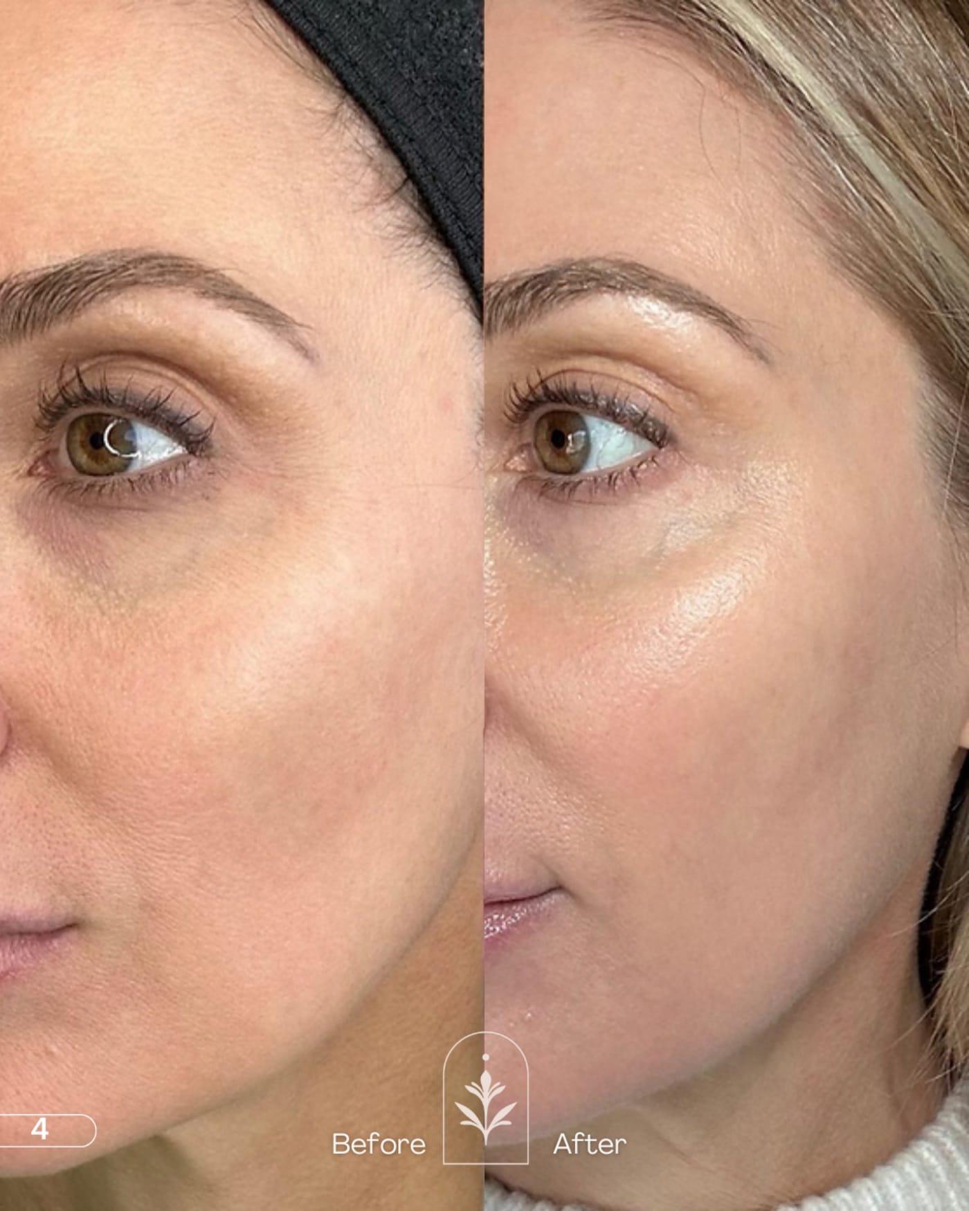 Traitement du regard et des cernes