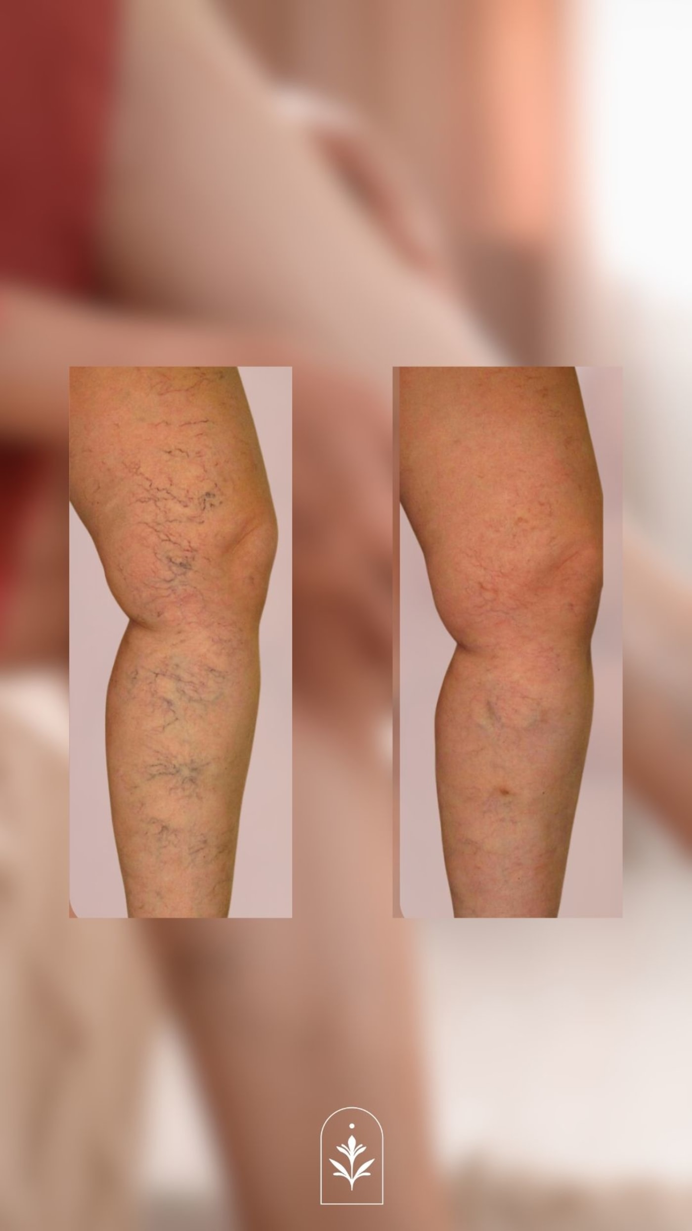 La méthode de précision laser