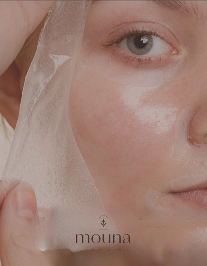 Custom chemical peel - Mouna MédiSpa