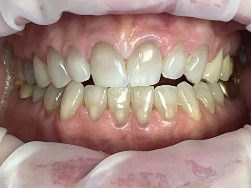 Never too late for a new smile hero