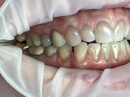 Side profile of smile showing alignment