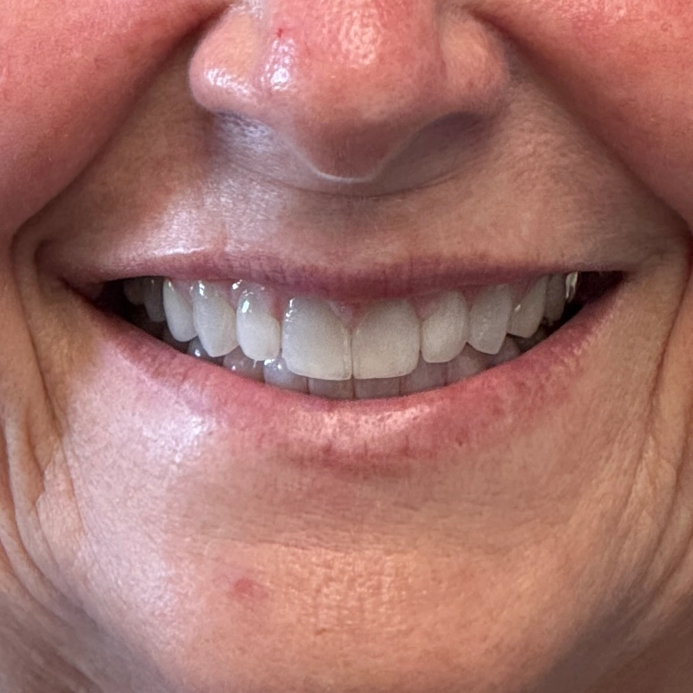Close-up of patient smile after whitening