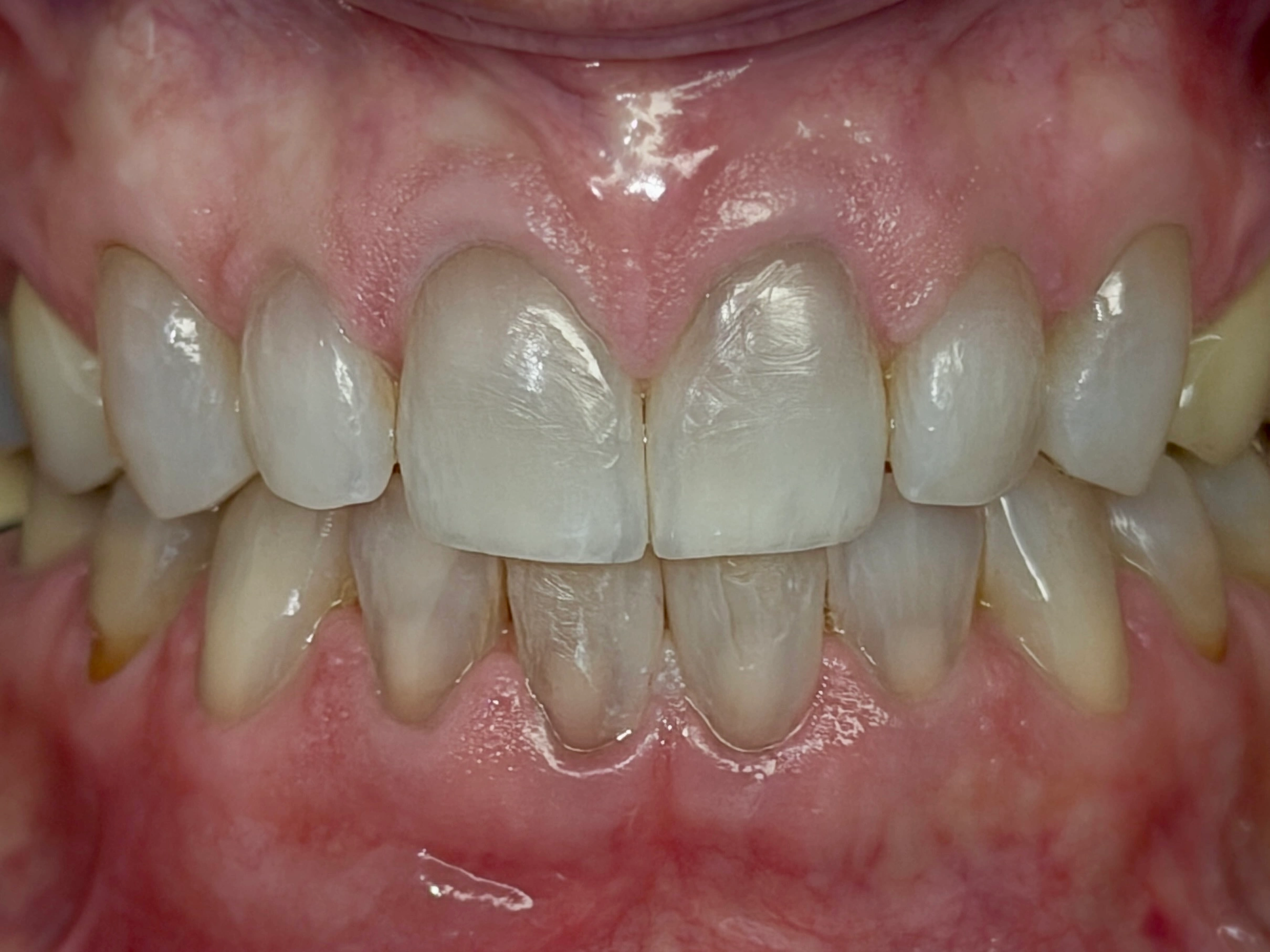 Lower front teeth after bonding