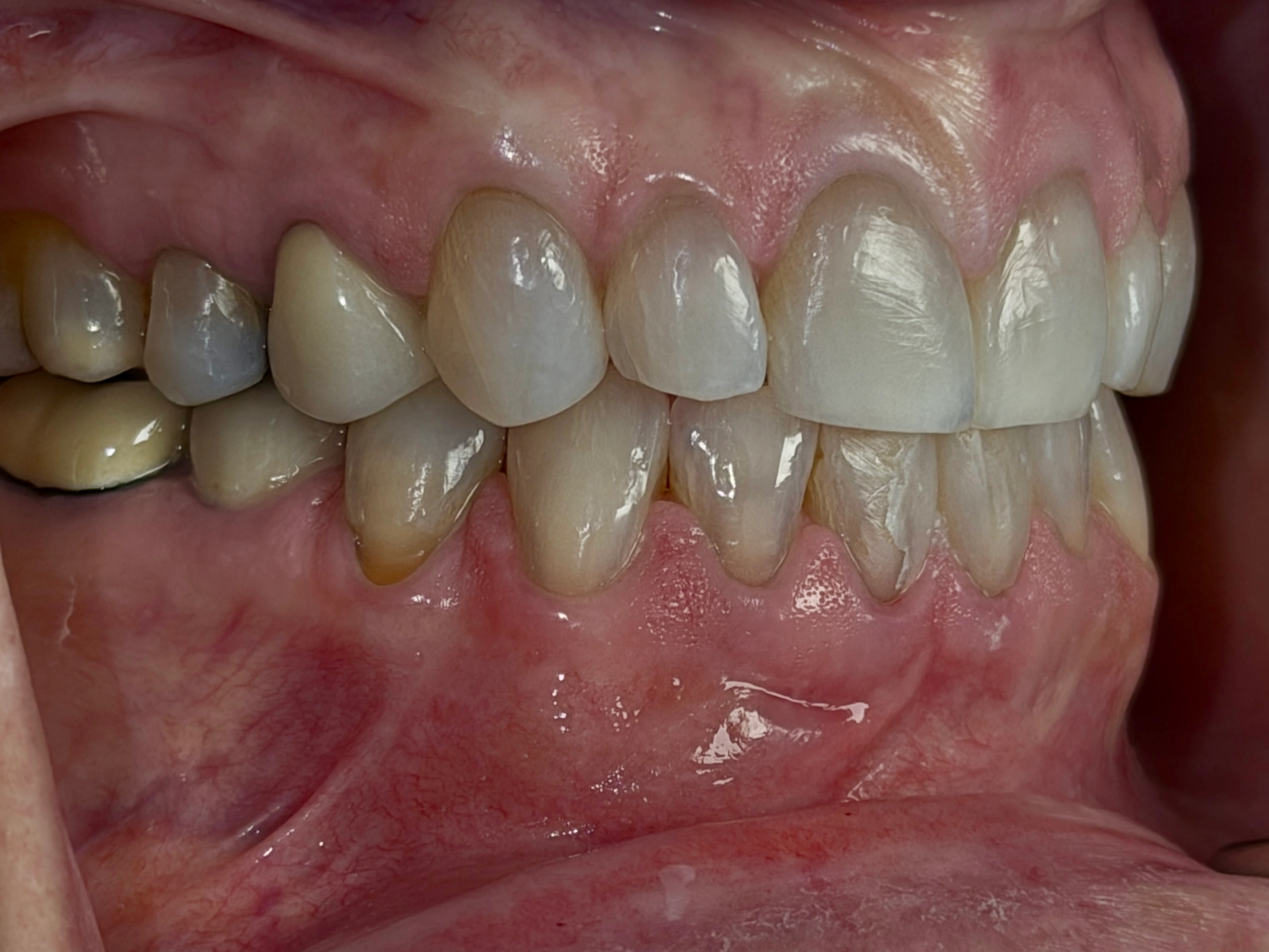 Upper teeth detail after whitening