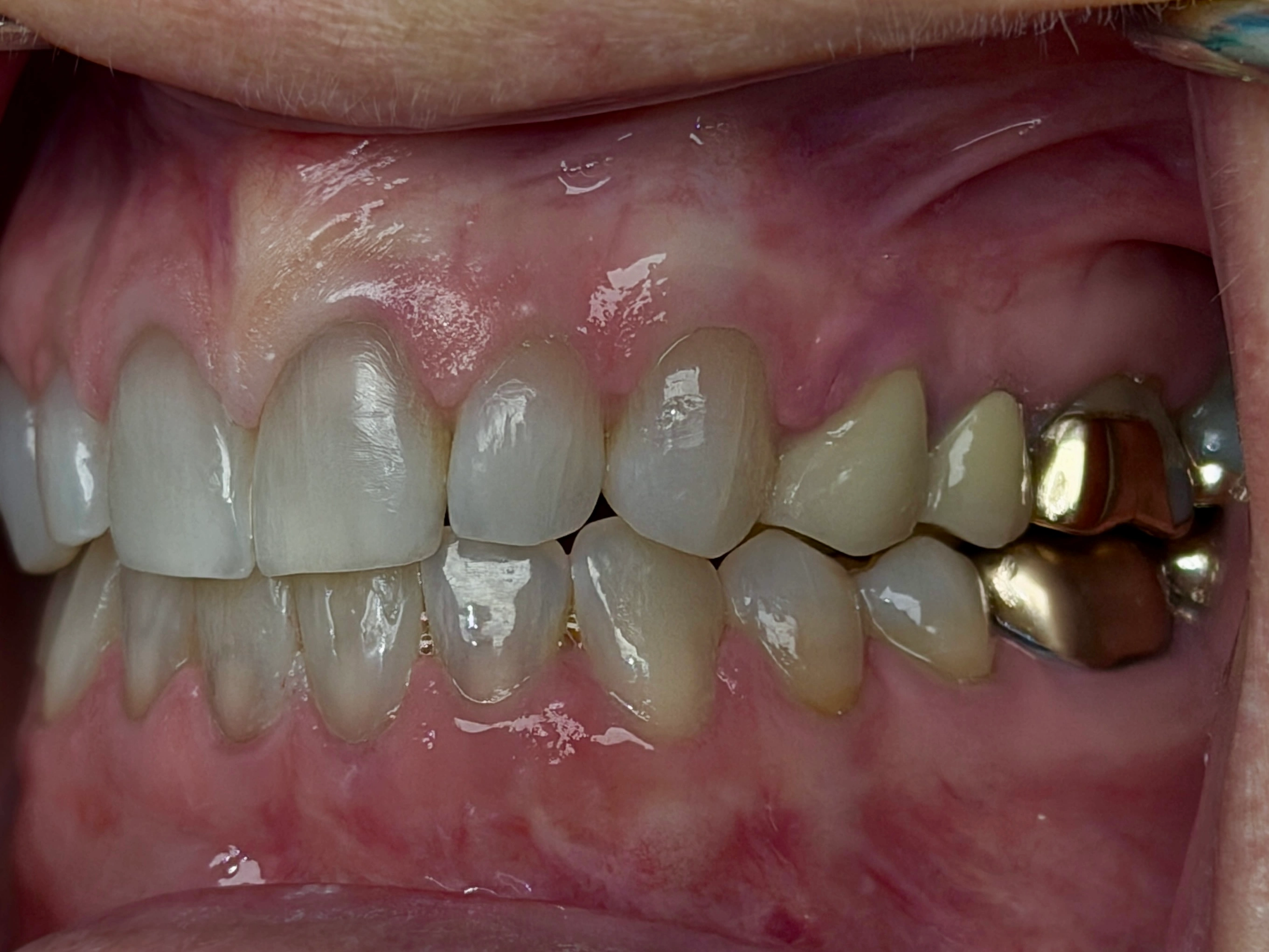 Lower teeth detail after black triangle closure