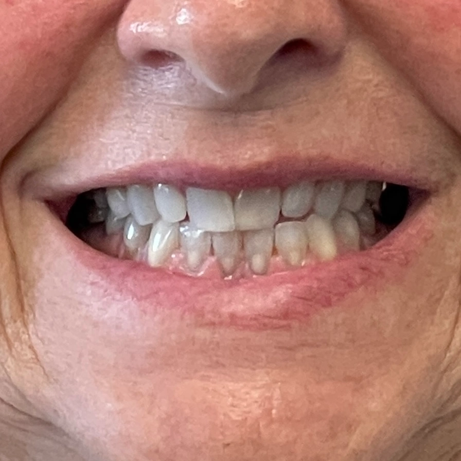 Aligned smile after Invisalign treatment