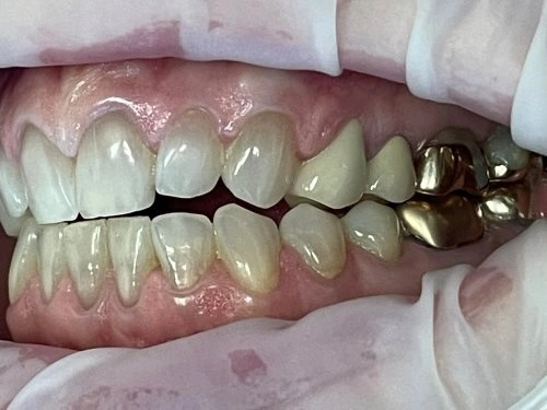 Smiling portrait with improved symmetry