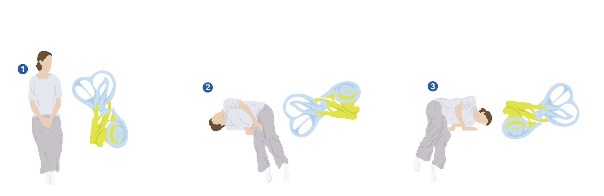 BPPV (Positional Vertigo) - symptoms, diagnosis, and treatment | hear.com