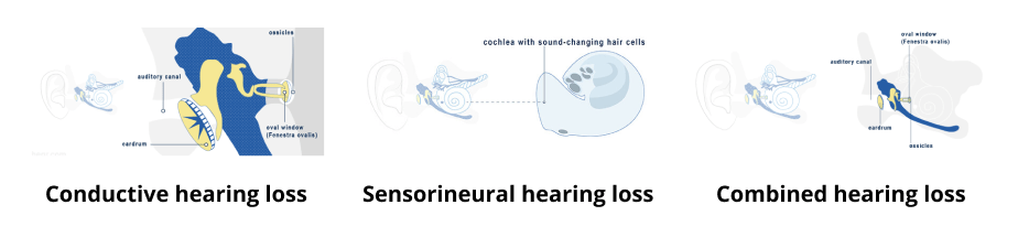 Types of hearing loss