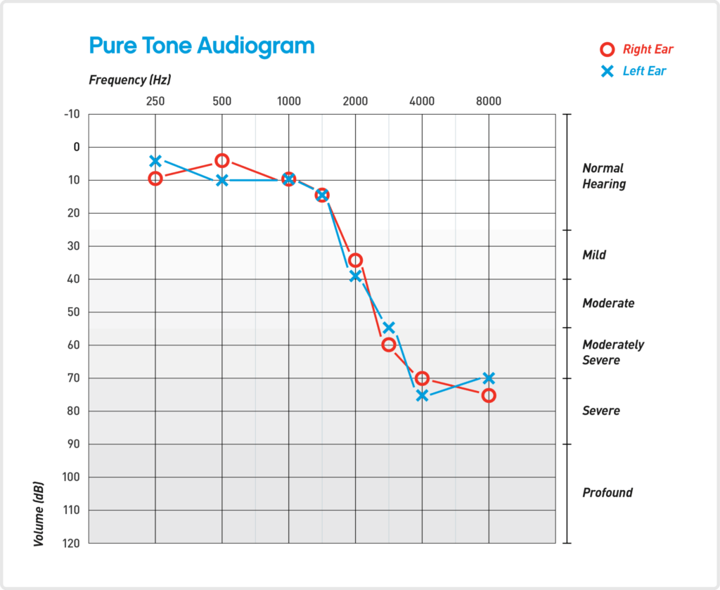 Pure Tone Audiogram Illustration