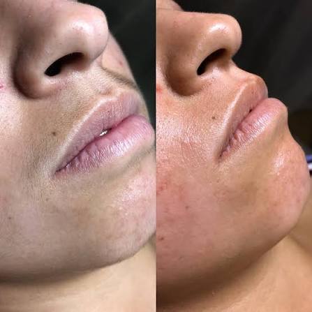 Lower LIP WAXING