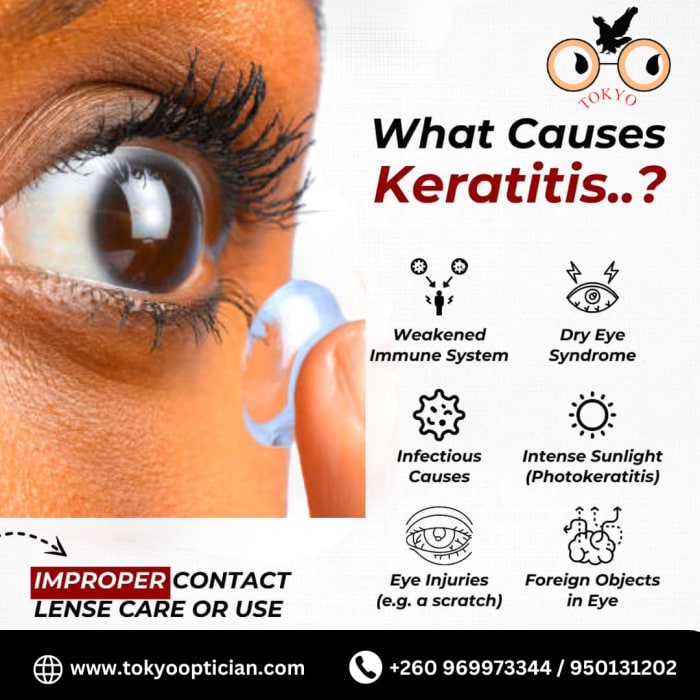 Understanding Keratitis: causes and risks
