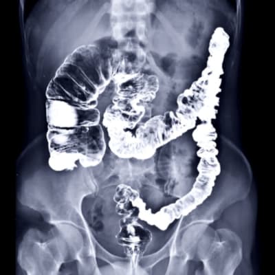 Digital X-Ray System - Barium-Enema image