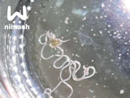 Вот и новая фобия: в лице у мужчины завелся червь после укуса комара