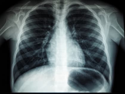 Тихий убийца: врач перечислил первые симптомы самого распространенного рака