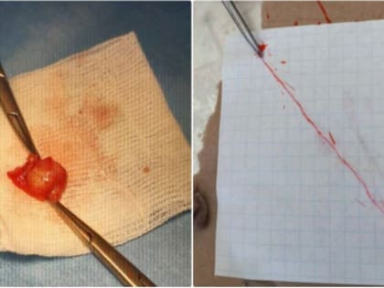 У подростка в мошонке завелся гигантский червь после укуса комара