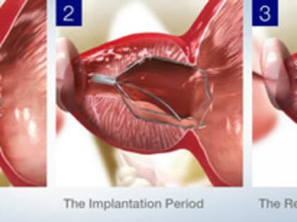 Исследование показало, что лечение аденомы простаты с iTind действует более четырех лет