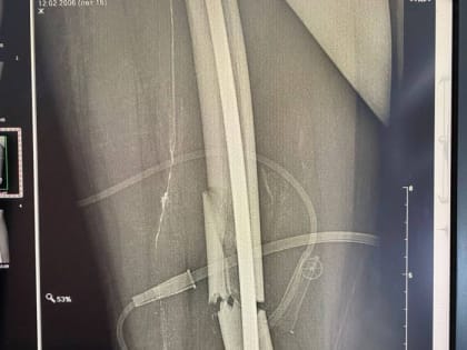 Оренбургские хирурги провели уникальную операцию подростку