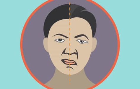 Paralisia Facial
