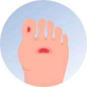 Diabetic Foot