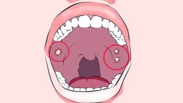 Oral cancer symptoms: संकेत जो बताते हैं कि आपको ओरल कैंसर हो सकता है, न करें नजरअंदाज