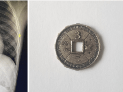 Врачи спасли жизнь 8-летнему мальчику, удалив монету из пищевода