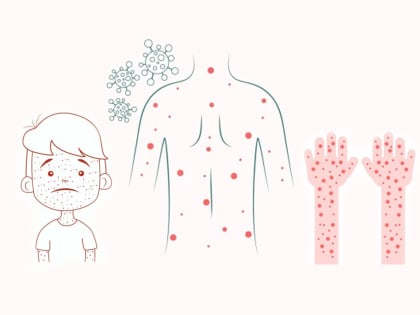 Что такое корь и чем она опасна