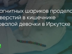 Иркутские хирурги спасли малышку, проглотившую больше десятка магнитных шариков
