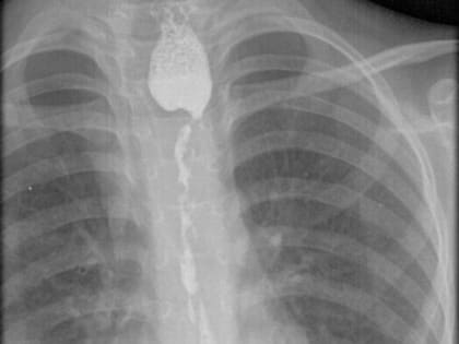 Хирурги ОГАУЗ ГИМДКБ успешно провели колоэзофагопластику