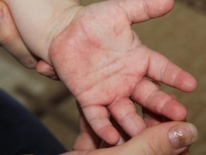 Ограничения ввели в Хабаровском крае из-за энтеровирусной инфекции