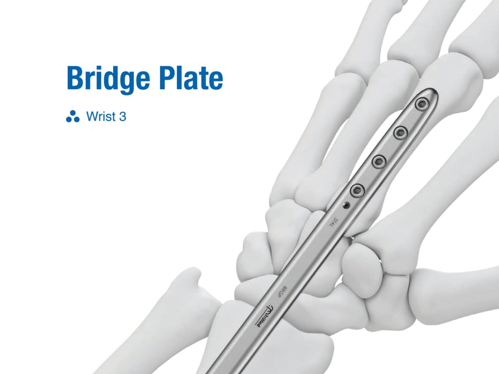Bridge Plate Surgical Technique