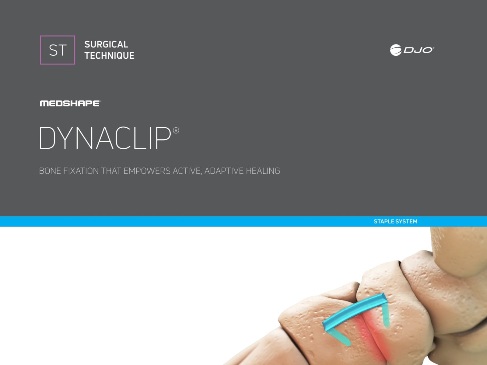 DynaClip Surgical Technique