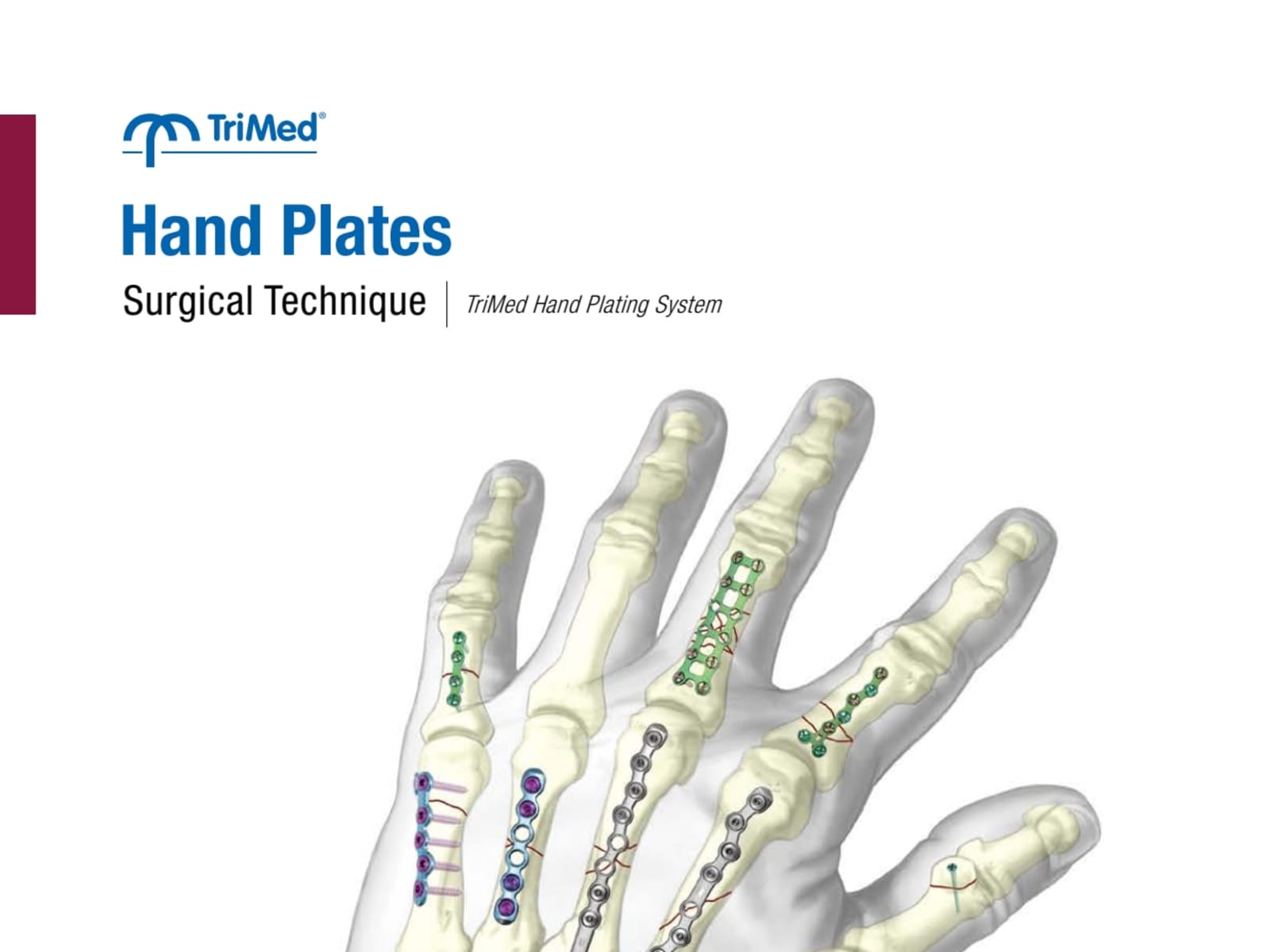 Hand Plate Surgical Technique