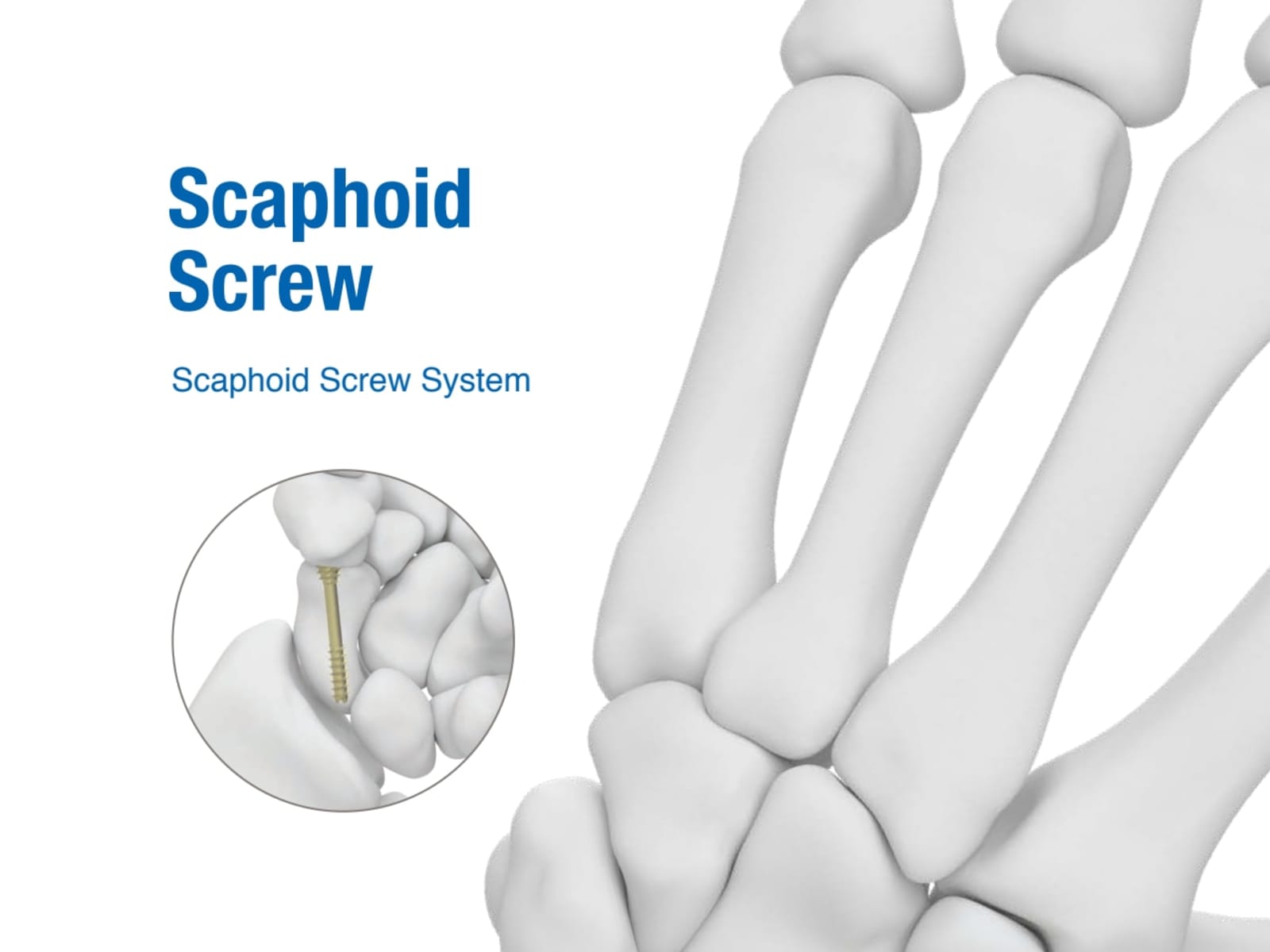 Scaphoid Screw Surigcal Technique