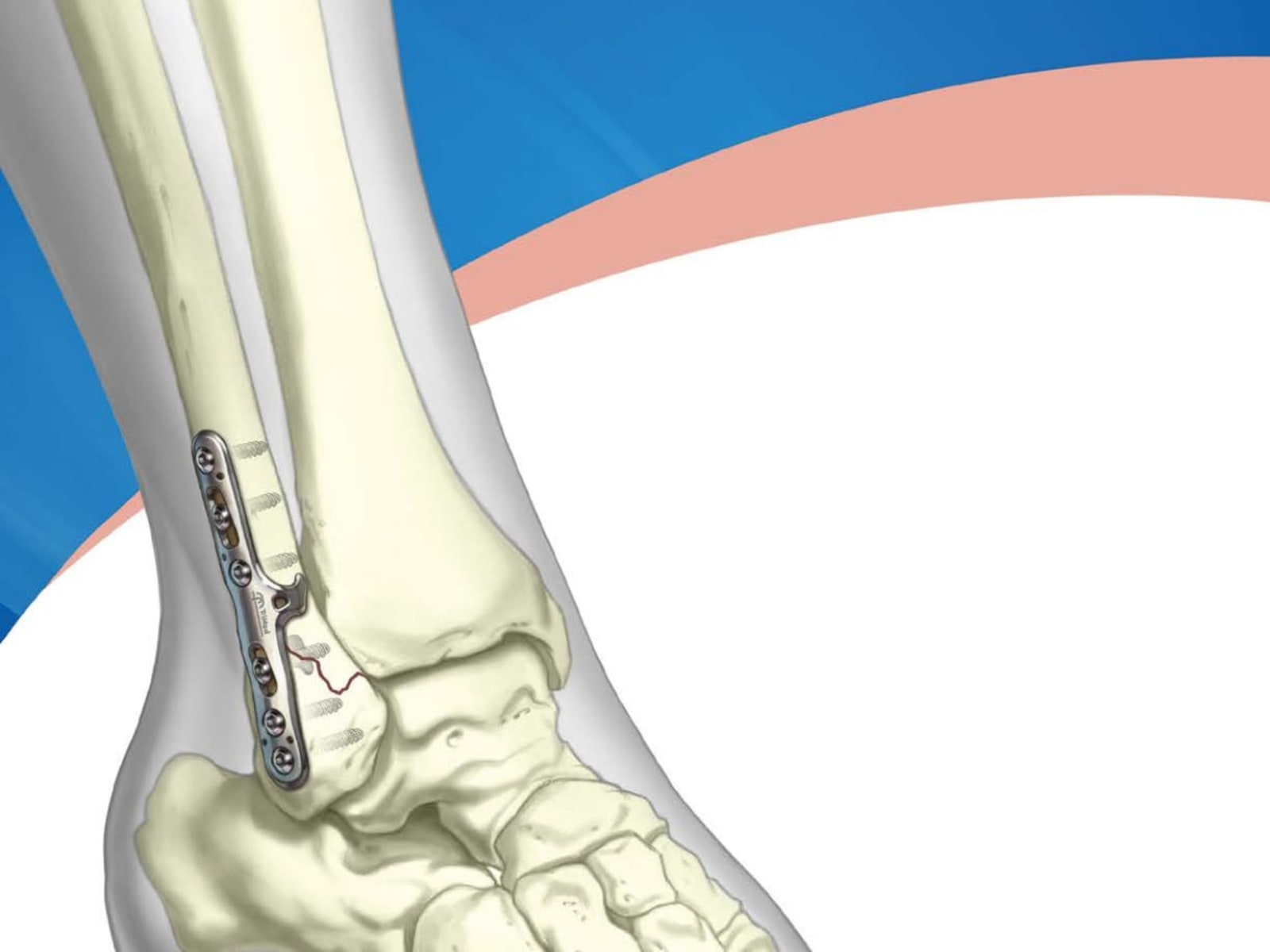 Sidewinder Surgical Technique