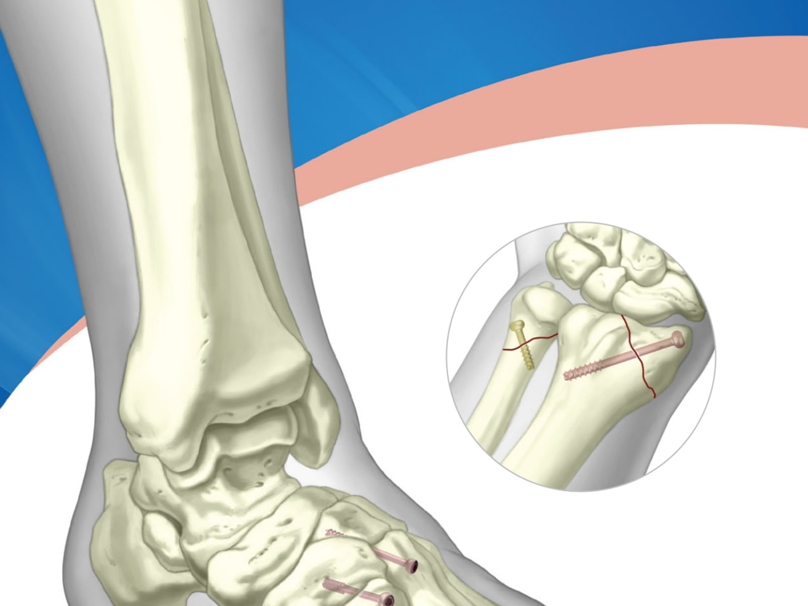 Trimed Small Headed Screws Surgical Technique