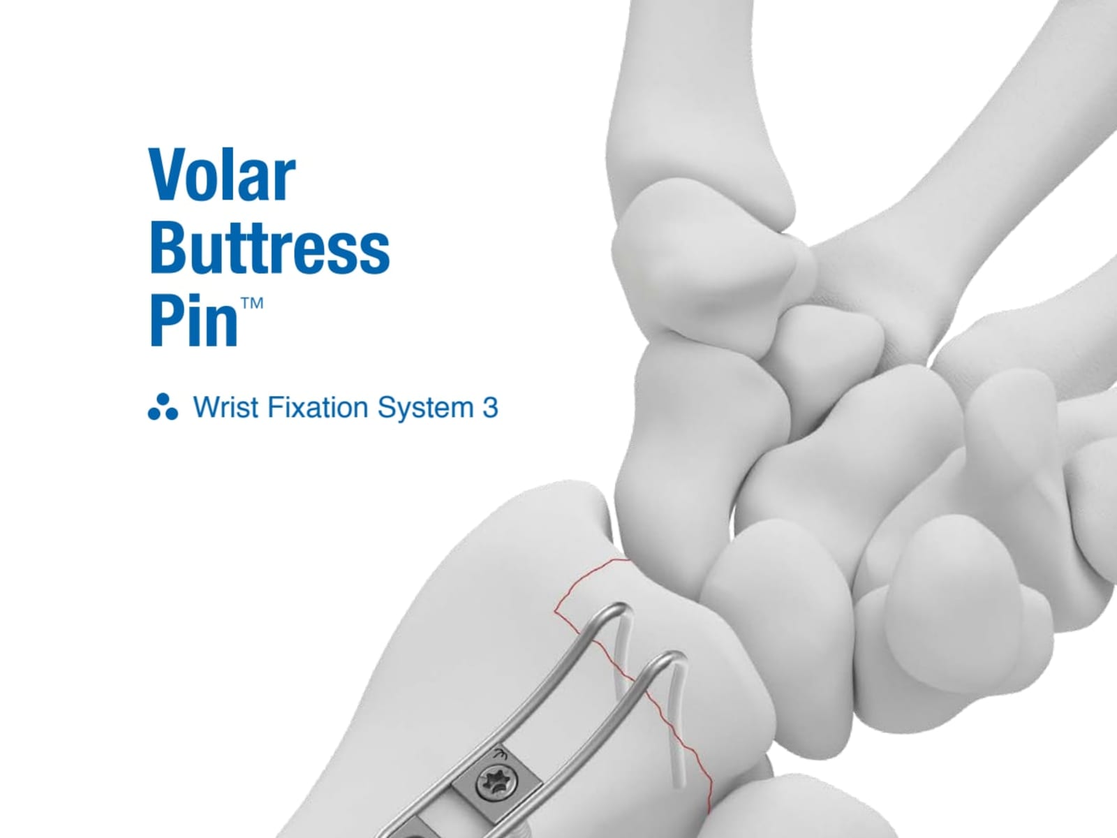 Volar Butress Pin Surgical Technique