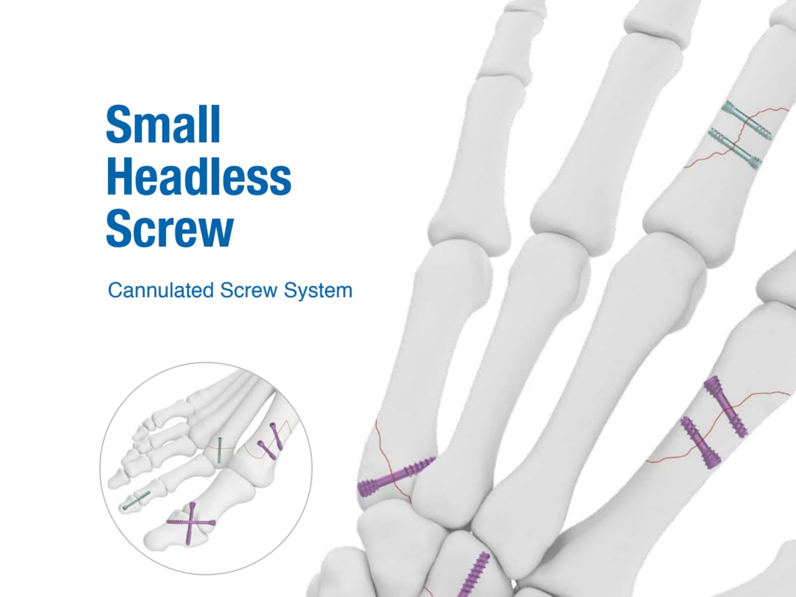 Trimed Small Headless Screws Surgical Technique