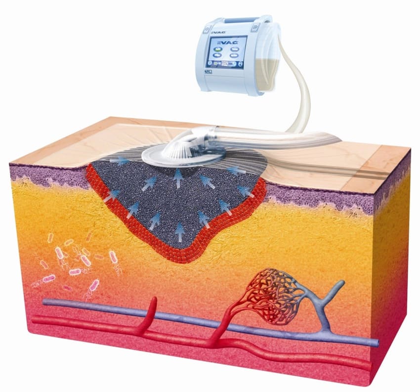 Vacuum Assisted Closure VAC Therapy India Chronic Wound Vacuum Assisted Closure VAC Therapy India Chronic Wound